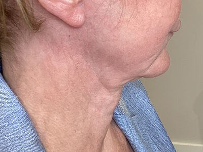 Case # 19 after photo