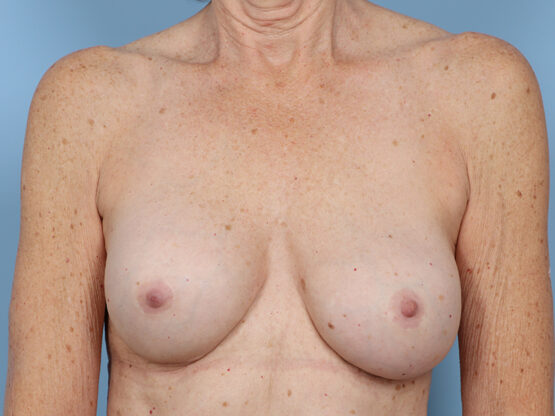 Case # 36 after photo