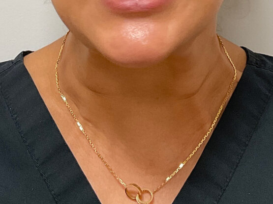 Case # 31 after photo