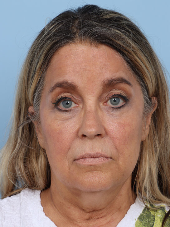 Case # 31 before photo