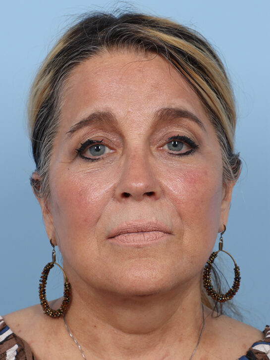 Case # 31 after photo