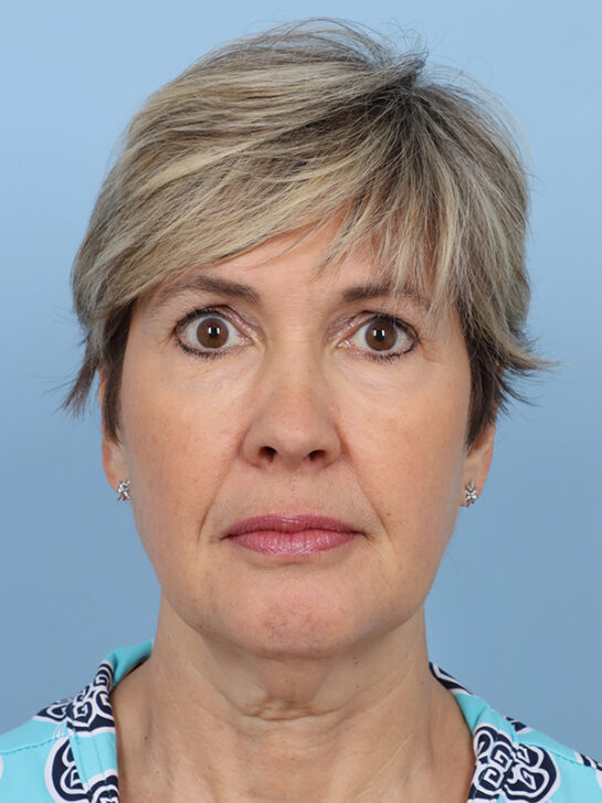 Case # 32 before photo