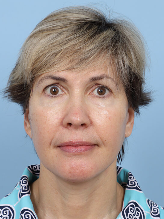 Case # 32 after photo