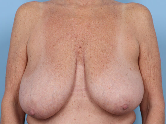 Case # 37 before photo