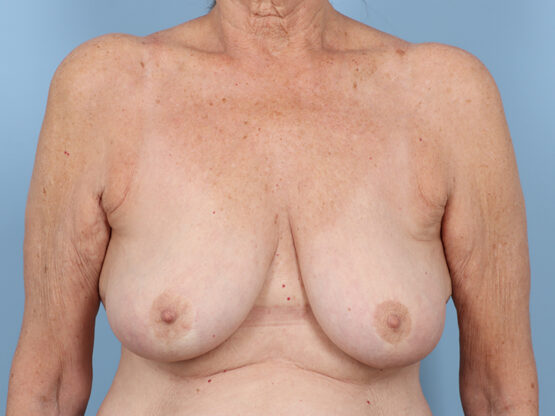 Case # 43 before photo