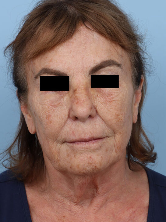 Case # 33 before photo