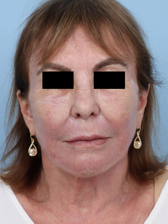 Case # 33 after photo