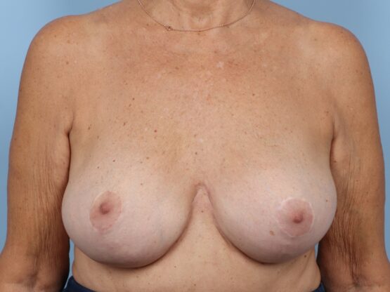 Case # 44 after photo