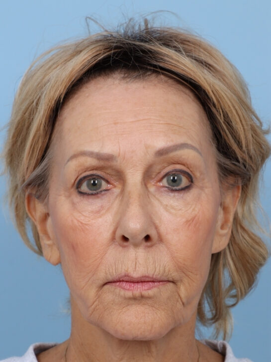 Case # 35 before photo