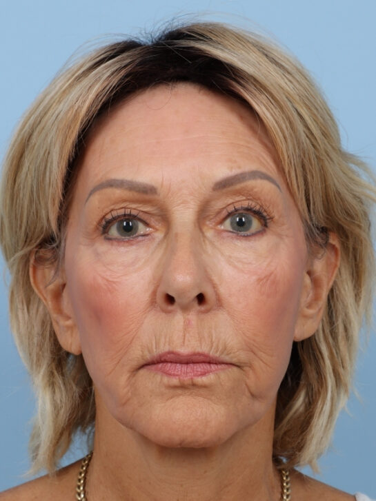 Case # 35 after photo