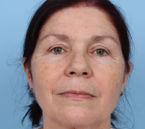 Case # 28 before photo