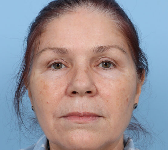 Case # 28 after photo