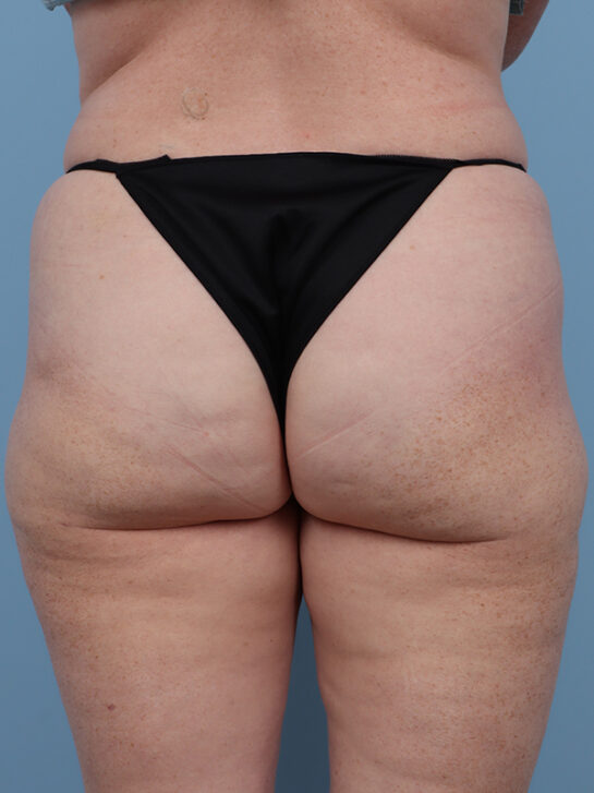 Case # 1 after photo