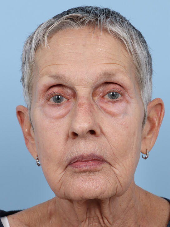 Case # 1 after photo