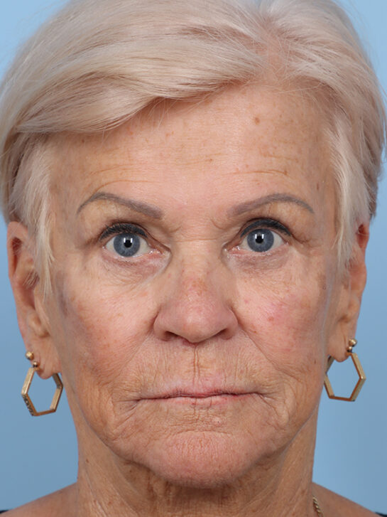 Case # 4 before photo