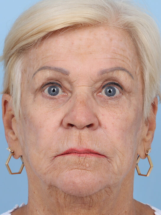 Case # 4 after photo