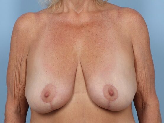 Case # 36 after photo