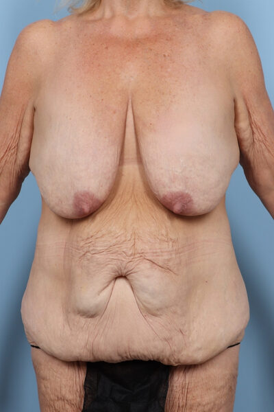 Case # 22 before photo