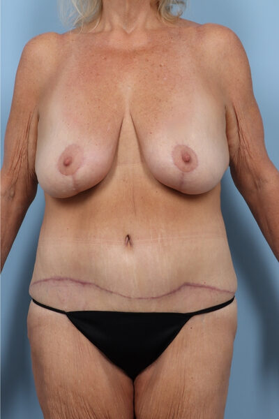 Case # 22 after photo