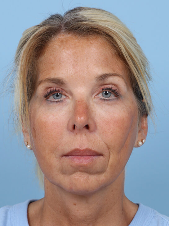 Case # 28 before photo