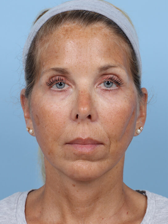 Case # 28 after photo