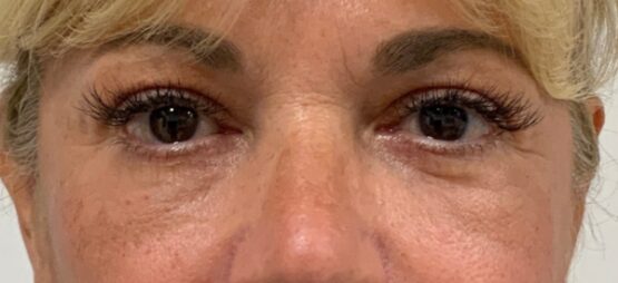 Case # 33 after photo