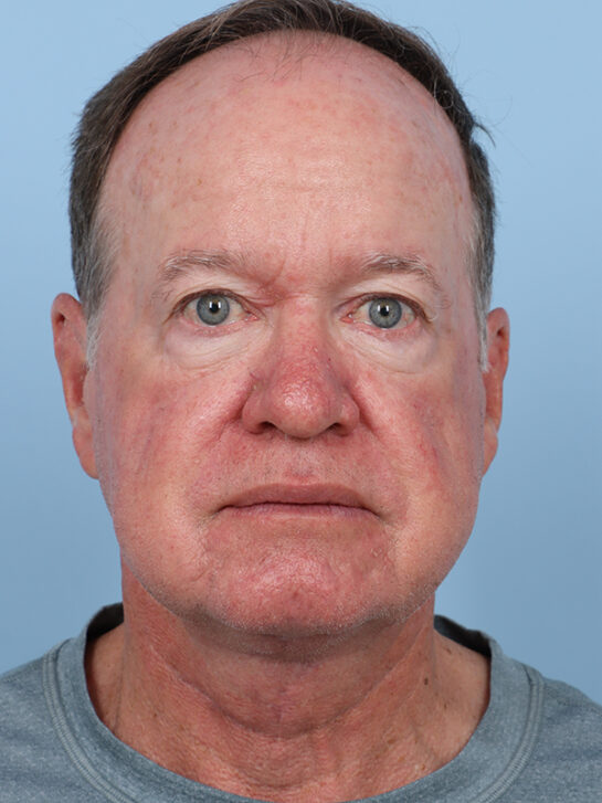 Case # 1 after photo